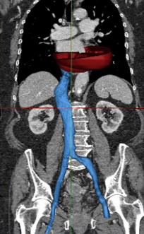 transfemoral access for the implantation of transcathether valve