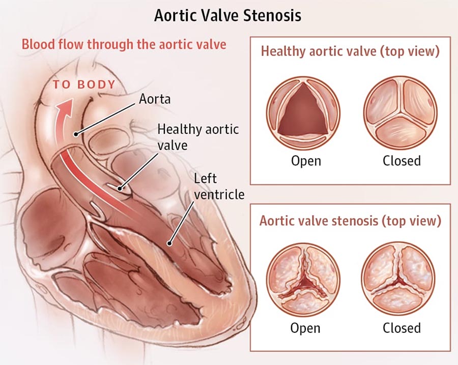 image of aortic valve stenosis