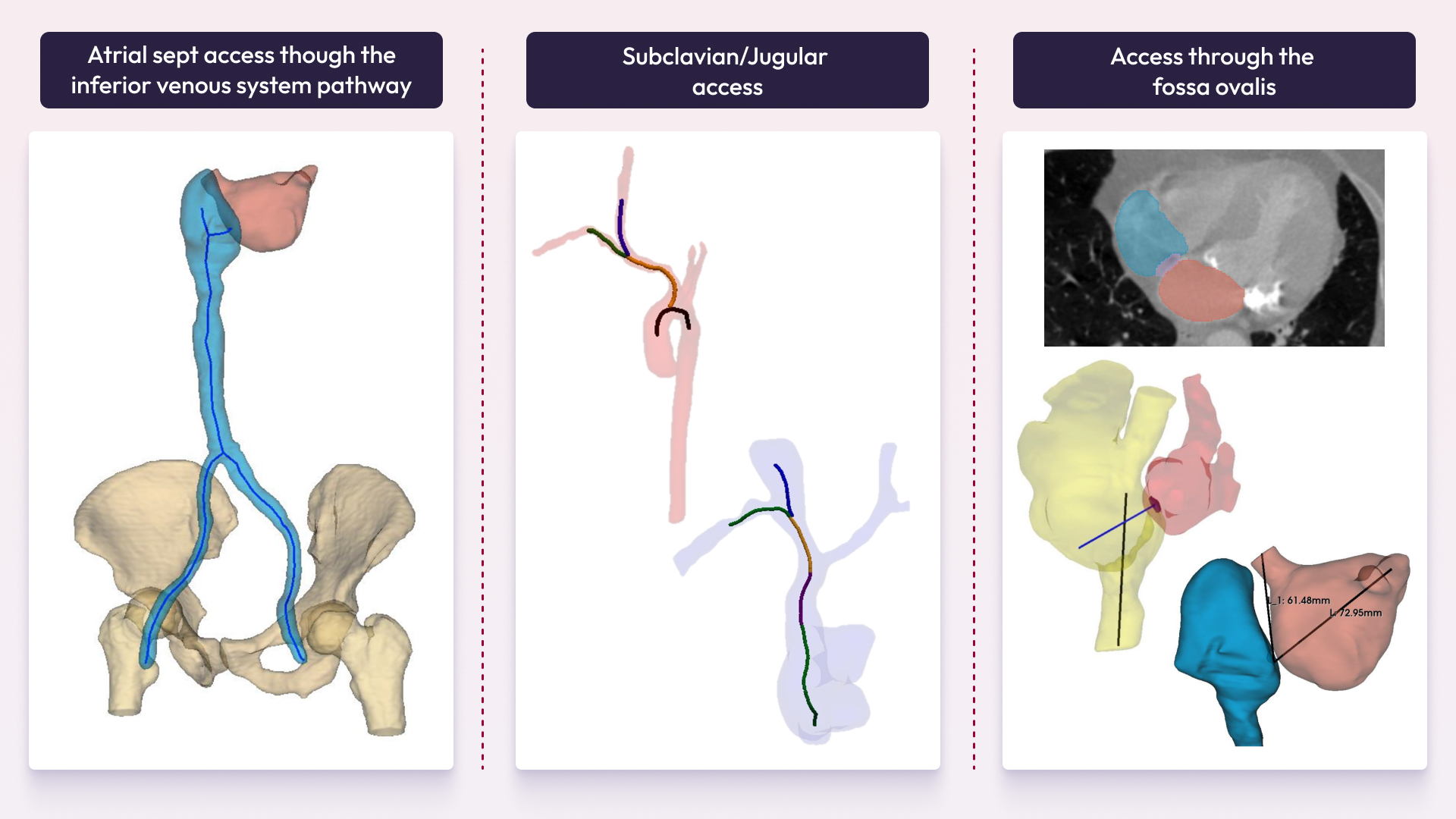 An inforgraphic showing three possible access routes for the catheterization procedure