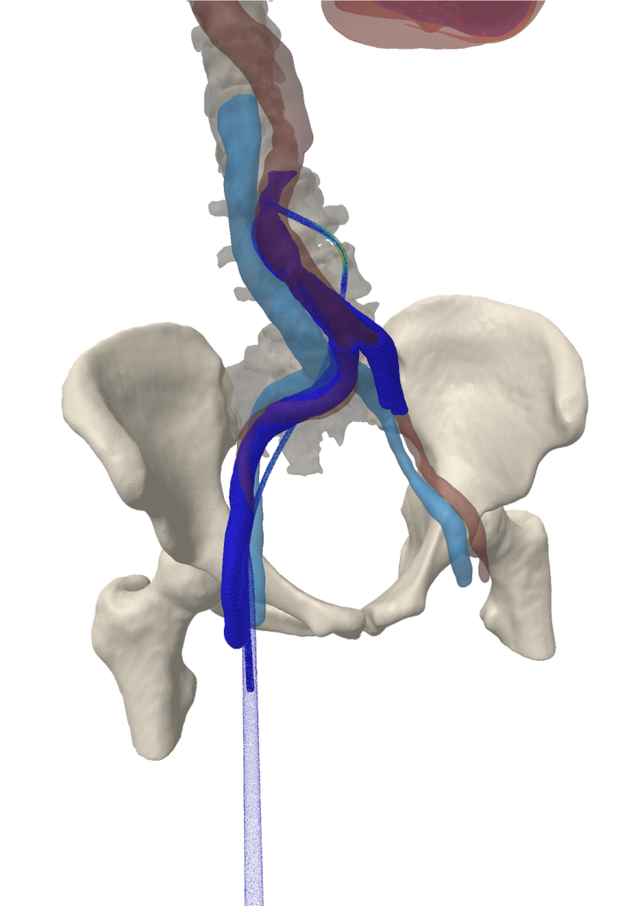 sheath insertion simulation
